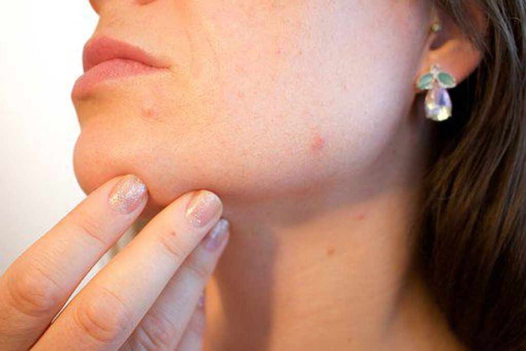 How to Get Rid of a Pimple