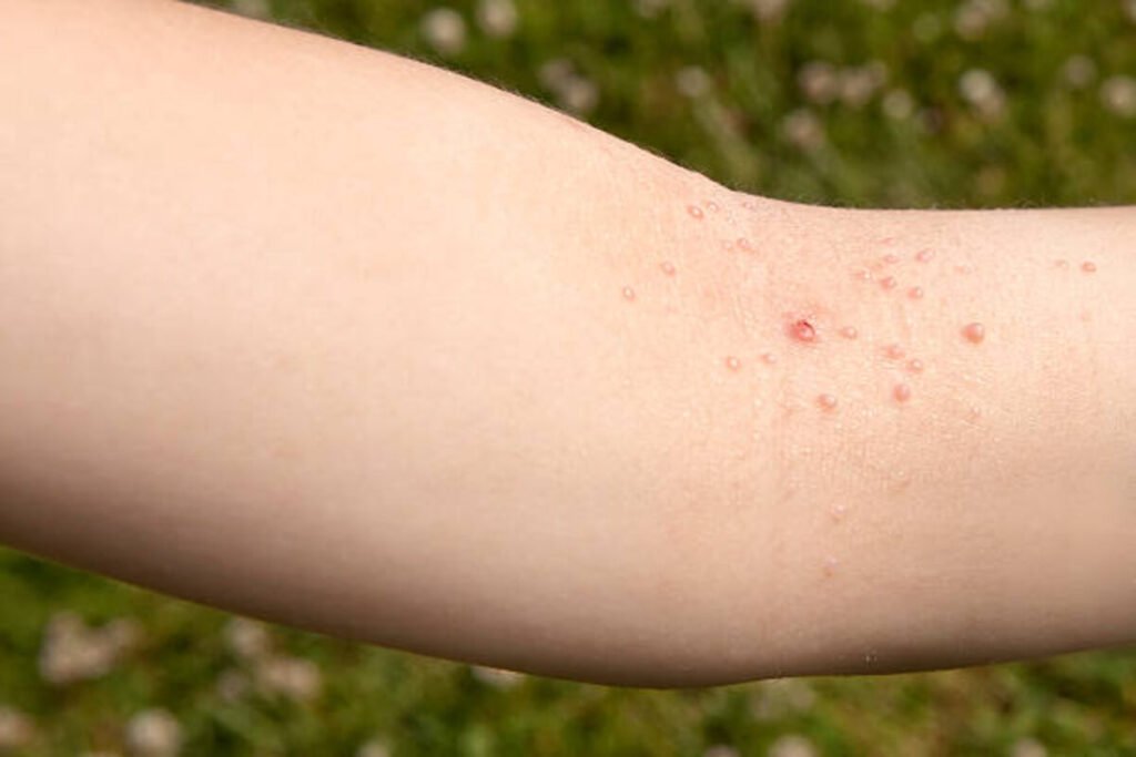 genital warts