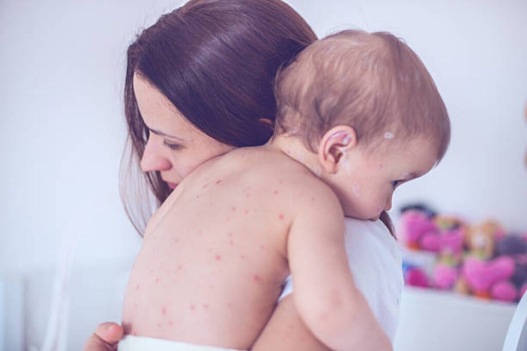 measles