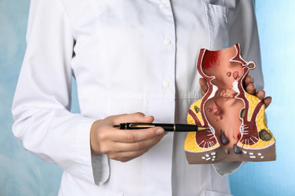 what is a hemorrhoid