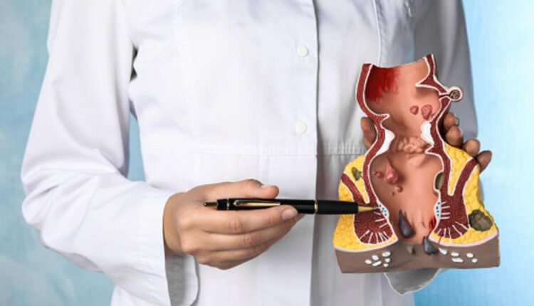 what is a hemorrhoid