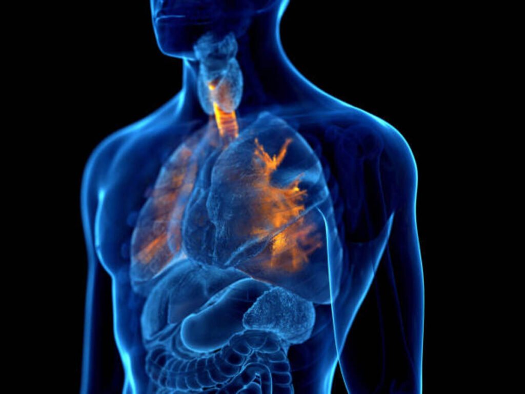 bronchiectasis